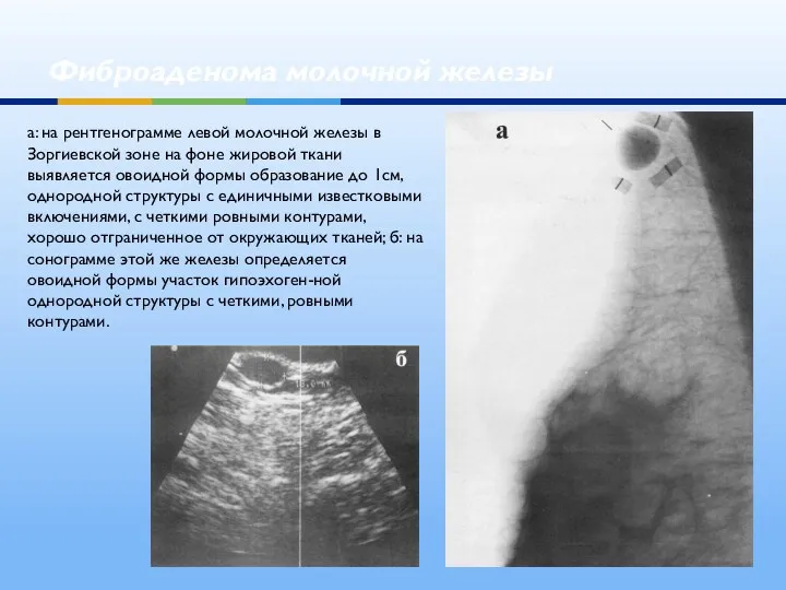 Фиброаденома молочной железы а: на рентгенограмме левой молочной железы в