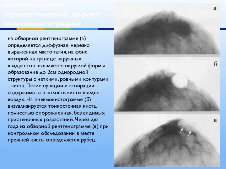 положительный терапевтический эффект пневмокистографии на обзорной рентгенограмме (а) определяется диффузная, нерезко выраженная мастопатия,