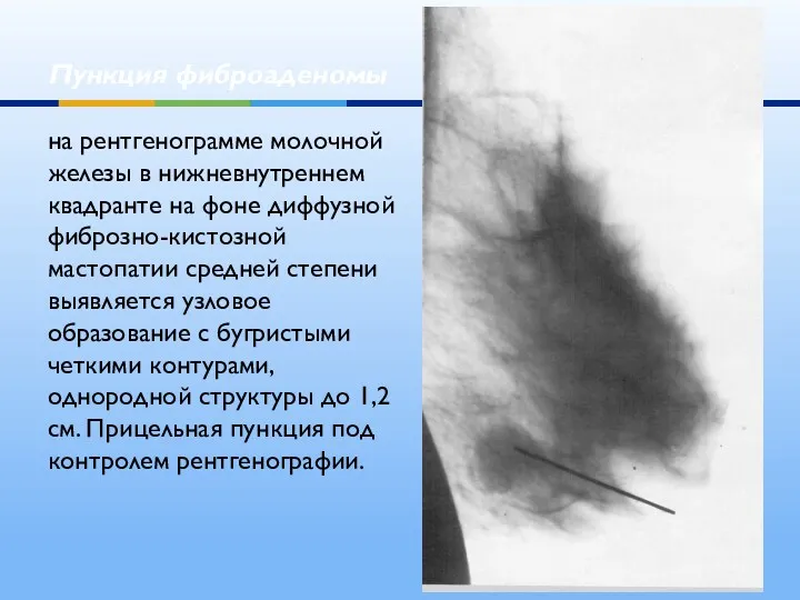 Пункция фиброаденомы на рентгенограмме молочной железы в нижневнутреннем квадранте на фоне диффузной фиброзно-кистозной