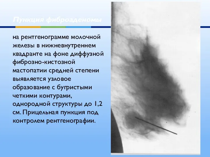 Пункция фиброаденомы на рентгенограмме молочной железы в нижневнутреннем квадранте на