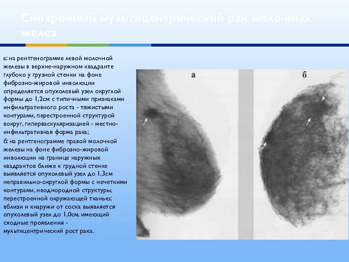 Синхронный мультицентрический рак молочных желез а: на рентгенограмме левой молочной железы в верхне-наружном