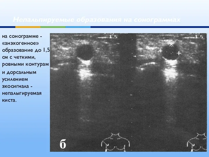 Непальпируемые образования на сонограммах на сонограмме - «анэхогенное» образование до