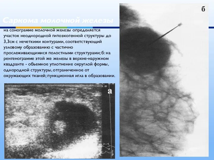 Саркома молочной железы на сонограмме молочной железы определяется участок неоднородной