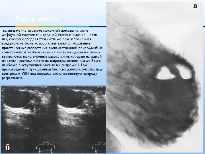 Рак в кисте на пневмокистограмме молочной железы на фоне диффузной мастопатии средней степени