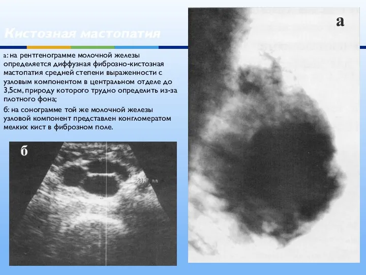 Кистозная мастопатия а: на рентгенограмме молочной железы определяется диффузная фиброзно-кистозная мастопатия средней степени