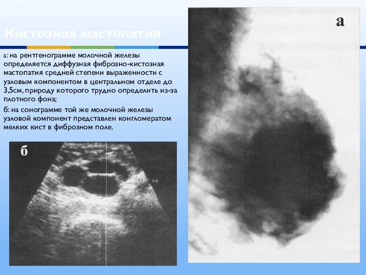 Кистозная мастопатия а: на рентгенограмме молочной железы определяется диффузная фиброзно-кистозная