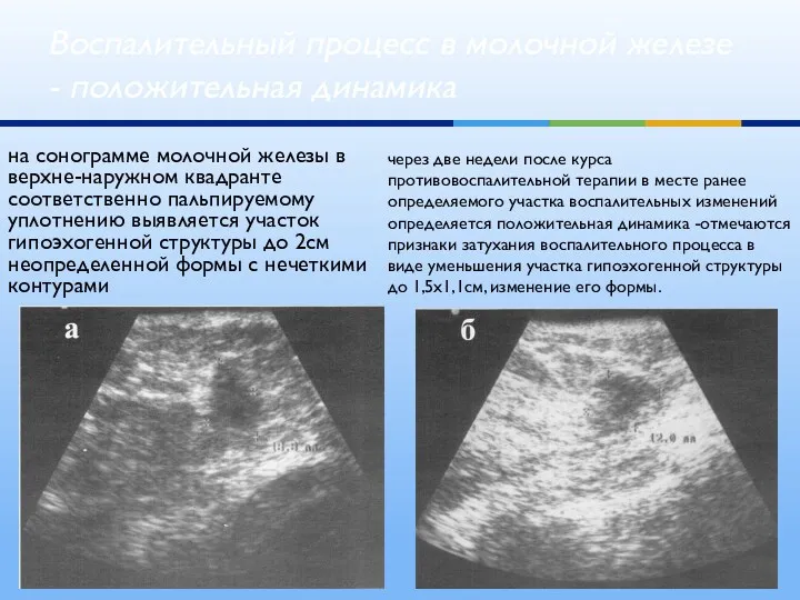 на сонограмме молочной железы в верхне-наружном квадранте соответственно пальпируемому уплотнению