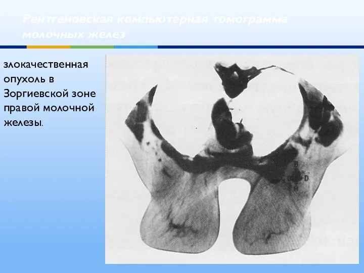 Рентгеновская компьютерная томограмма молочных желез злокачественная опухоль в Зоргиевской зоне правой молочной железы.
