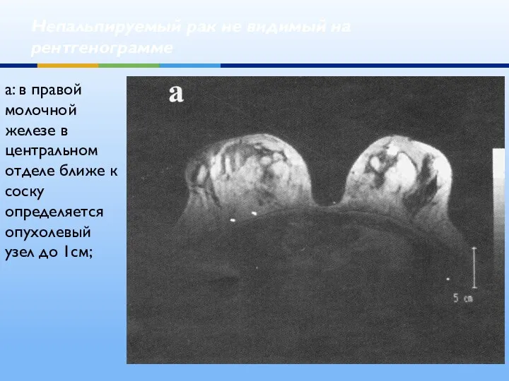 Непальпируемый рак не видимый на рентгенограмме а: в правой молочной железе в центральном