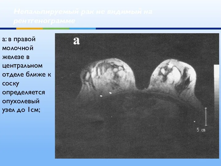 Непальпируемый рак не видимый на рентгенограмме а: в правой молочной