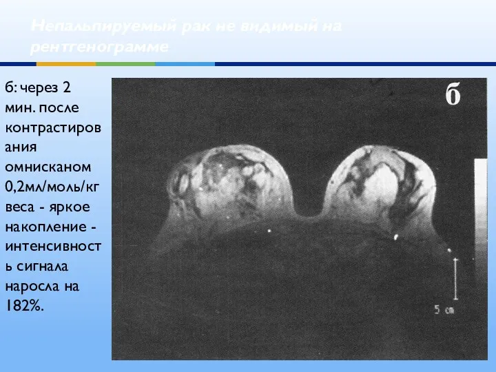 Непальпируемый рак не видимый на рентгенограмме б: через 2 мин. после контрастирования омнисканом