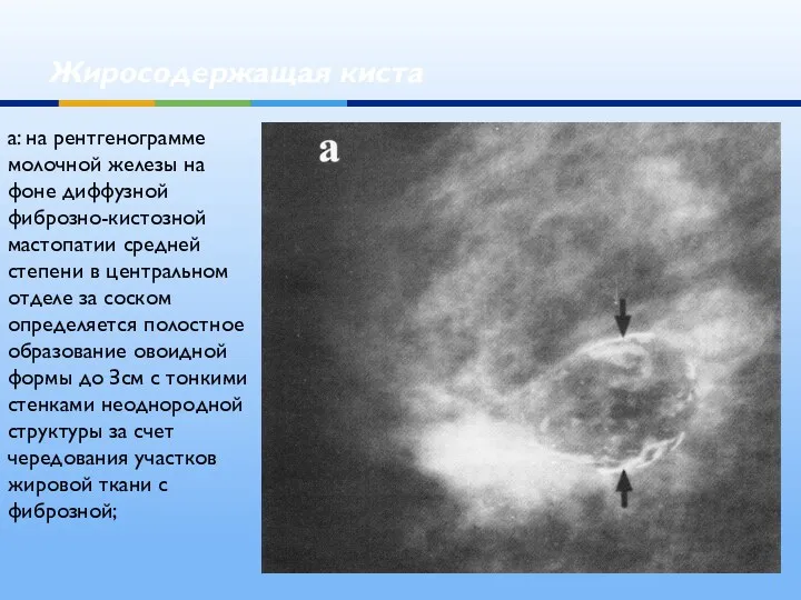 Жиросодержащая киста а: на рентгенограмме молочной железы на фоне диффузной фиброзно-кистозной мастопатии средней