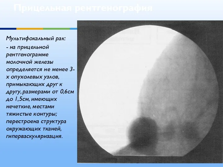 Прицельная рентгенография Мультифокалъный рак: - на прицельной рентгенограмме молочной железы определяется не менее