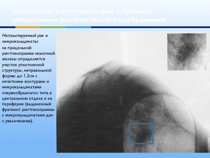прицельная рентгенография с прямым увеличением рентгеновского изображения Непальпируемый рак и микрокальцинаты: на прицельной