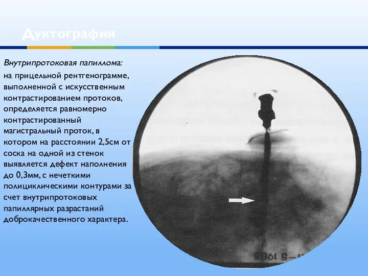 Дуктография Внутрипротоковая папиллома: на прицельной рентгенограмме, выполненной с искусственным контрастированием протоков, определяется равномерно