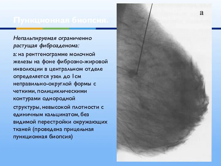 Пункционная биопсия. Непальпируемая ограниченно растущая фиброаденома: а: на рентгенограмме молочной железы на фоне