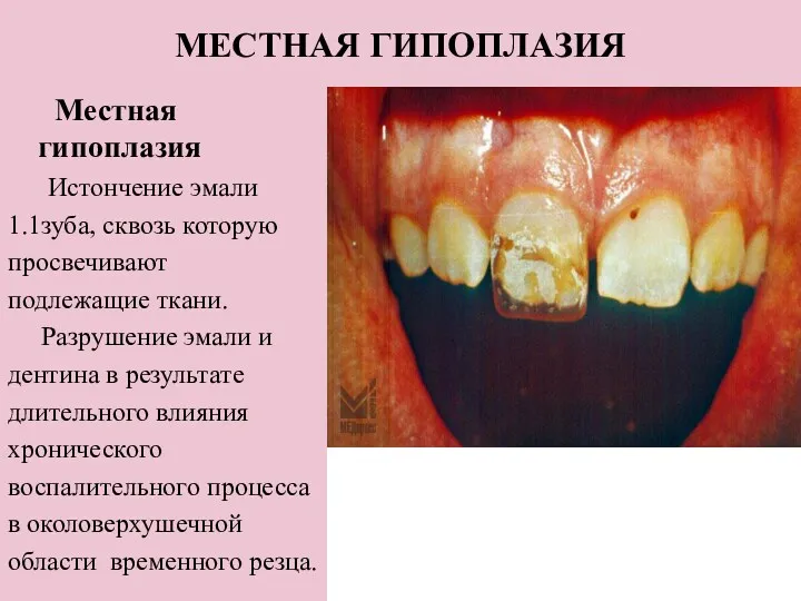 МЕСТНАЯ ГИПОПЛАЗИЯ Местная гипоплазия Истончение эмали 1.1зуба, сквозь которую просвечивают