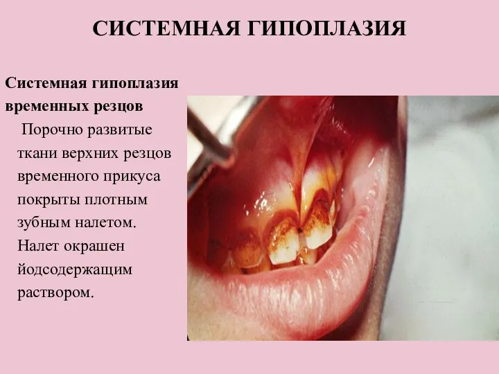 СИСТЕМНАЯ ГИПОПЛАЗИЯ Системная гипоплазия временных резцов Порочно развитые ткани верхних