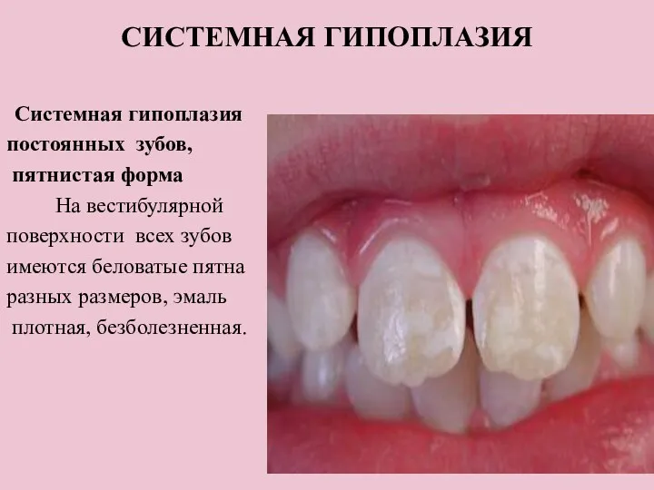 СИСТЕМНАЯ ГИПОПЛАЗИЯ Системная гипоплазия постоянных зубов, пятнистая форма На вестибулярной