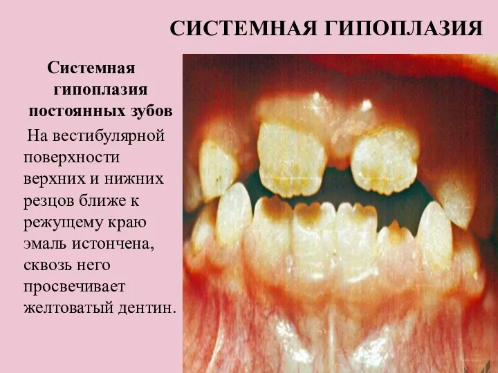 СИСТЕМНАЯ ГИПОПЛАЗИЯ Системная гипоплазия постоянных зубов На вестибулярной поверхности верхних