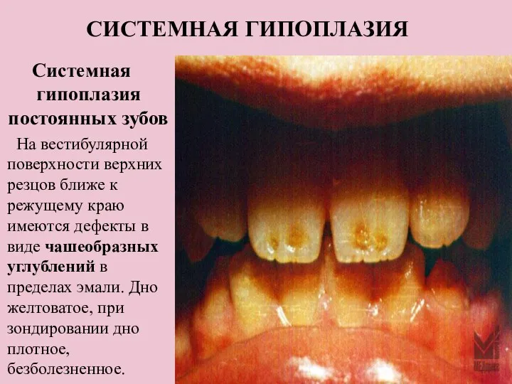 СИСТЕМНАЯ ГИПОПЛАЗИЯ Системная гипоплазия постоянных зубов На вестибулярной поверхности верхних