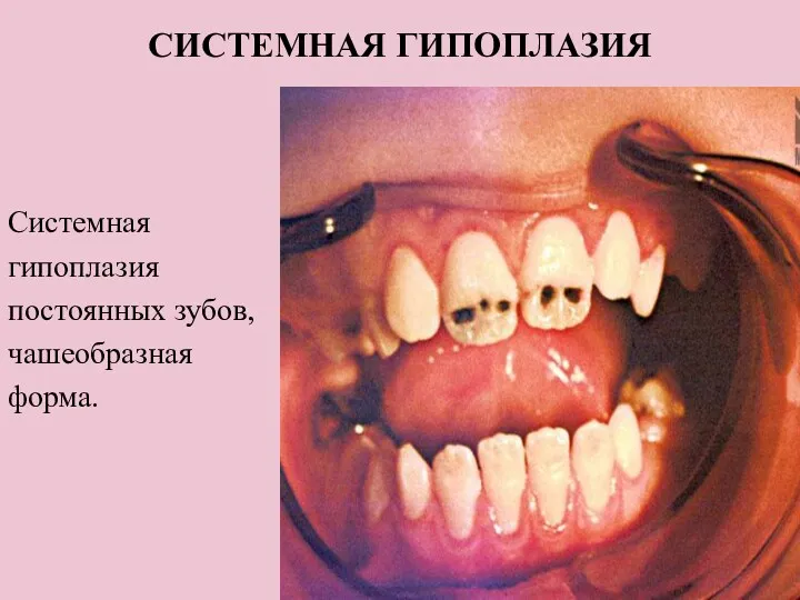 СИСТЕМНАЯ ГИПОПЛАЗИЯ Системная гипоплазия постоянных зубов, чашеобразная форма.