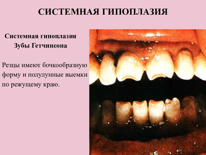 СИСТЕМНАЯ ГИПОПЛАЗИЯ Системная гипоплазия Зубы Гетчинсона Резцы имеют бочкообразную форму и полулунные выемки по режущему краю.