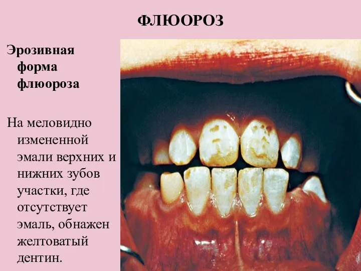 ФЛЮОРОЗ Эрозивная форма флюороза На меловидно измененной эмали верхних и