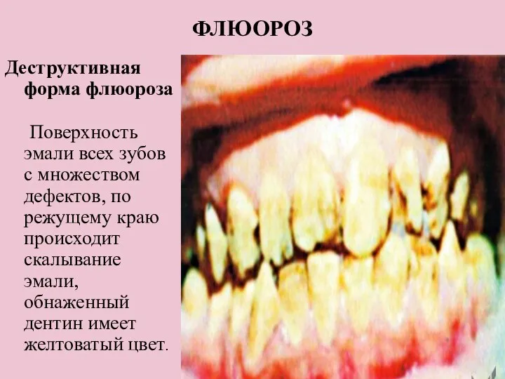 ФЛЮОРОЗ Деструктивная форма флюороза Поверхность эмали всех зубов с множеством