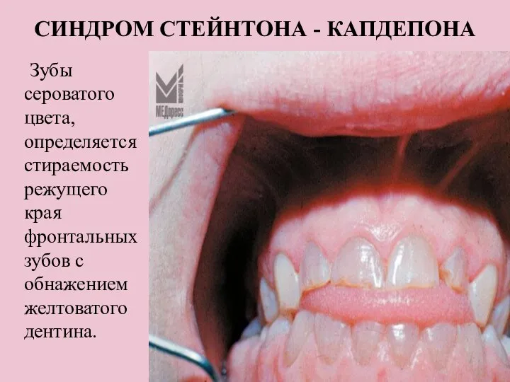 СИНДРОМ СТЕЙНТОНА - КАПДЕПОНА Зубы сероватого цвета, определяется стираемость режущего