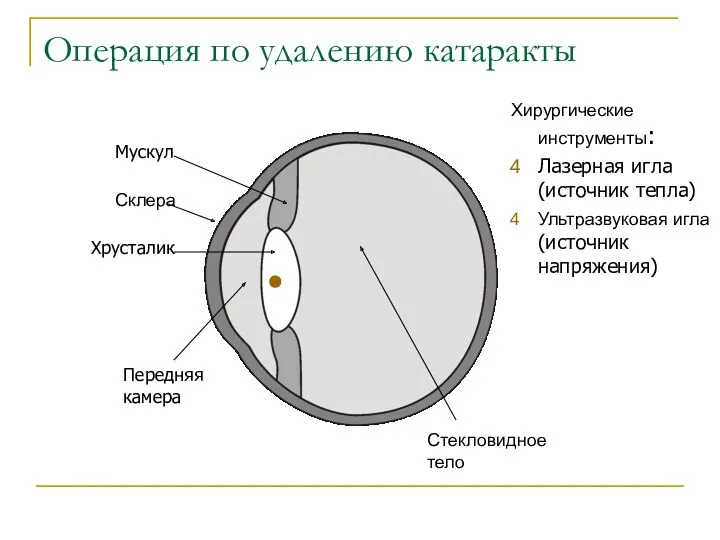 Операция по удалению катаракты Склера Стекловидное тело Мускул Хрусталик Передняя камера Хирургические инструменты: