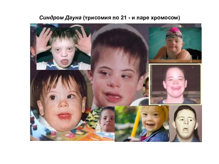 Синдром Дауна (трисомия по 21 - и паре хромосом)
