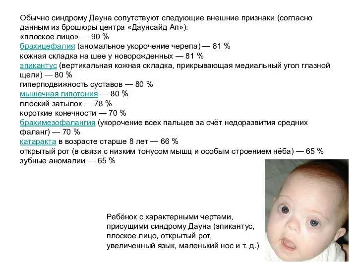 Обычно синдрому Дауна сопутствуют следующие внешние признаки (согласно данным из брошюры центра «Даунсайд