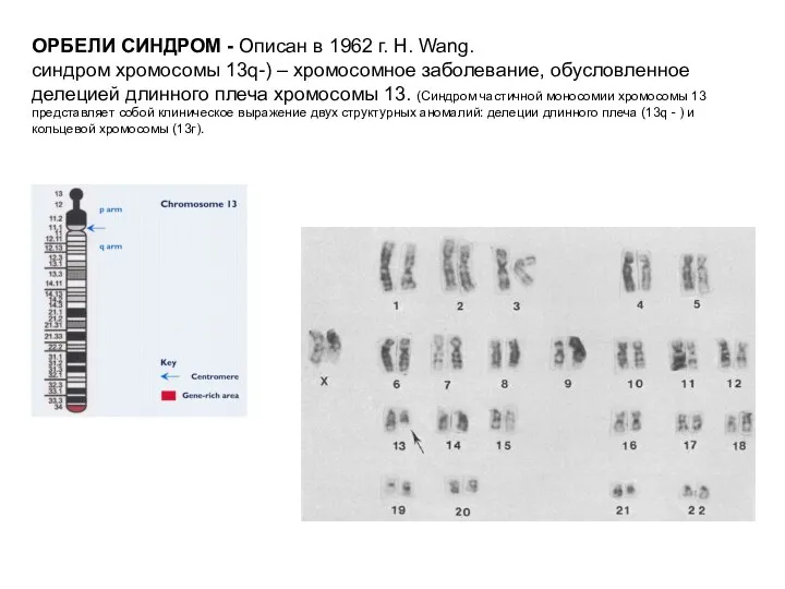 ОРБЕЛИ СИНДРОМ - Описан в 1962 г. Н. Wang. синдром хромосомы 13q-) –