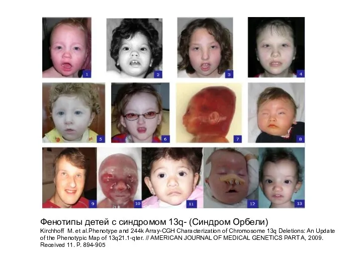 Фенотипы детей с синдромом 13q- (Синдром Орбели) Kirchhoff M. et al.Phenotype and 244k
