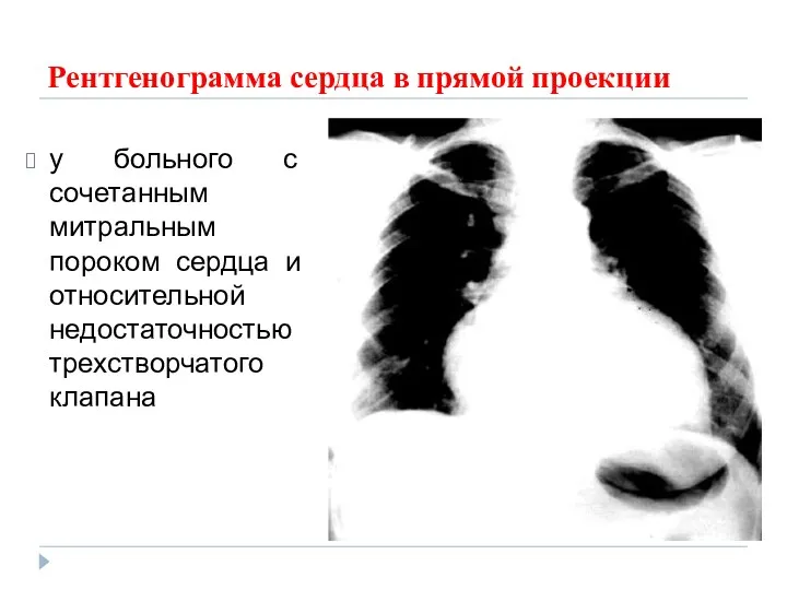 Рентгенограмма сердца в прямой проекции у больного с сочетанным митральным пороком сердца и