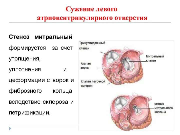 Сужение левого атриовентрикулярного отверстия Стеноз митральный формируется за счет утолщения,