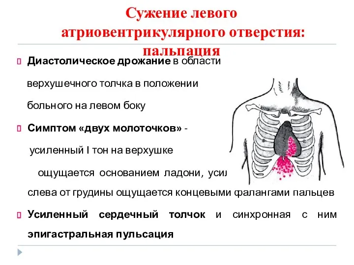 Сужение левого атриовентрикулярного отверстия: пальпация Диастолическое дрожание в области верхушечного