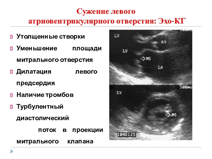 Сужение левого атриовентрикулярного отверстия: Эхо-КГ Утолщенные створки Уменьшение площади митрального отверстия Дилатация левого