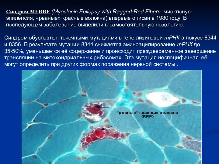 Синдром MERRF (Myoclonic Epilepsy with Ragged-Red Fibers, миоклонус-эпилепсия, «рваные» красные волокна) впервые описан
