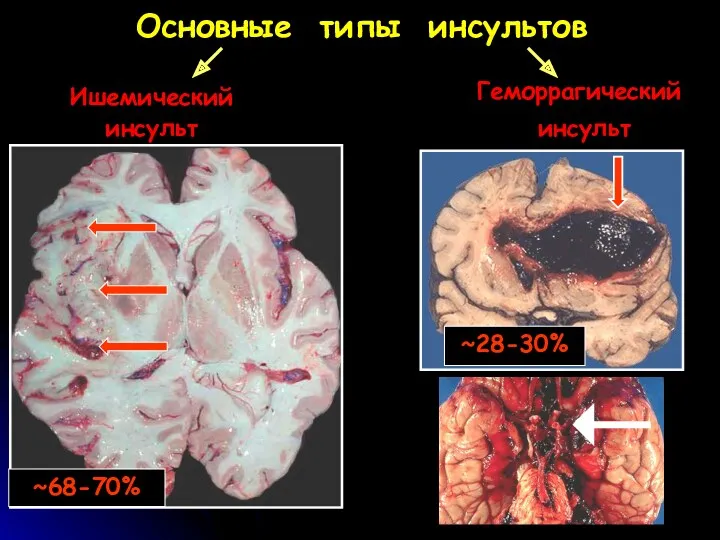 Основные типы инсультов Геморрагический инсульт Ишемический инсульт ~68-70% ~28-30%