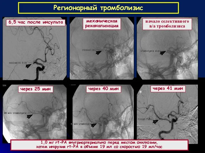 Регионарный тромболизис 6,5 час после инсульта механическая реканализация начало селективного