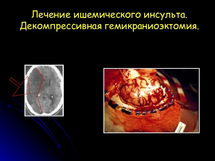 Лечение ишемического инсульта. Декомпрессивная гемикраниоэктомия.