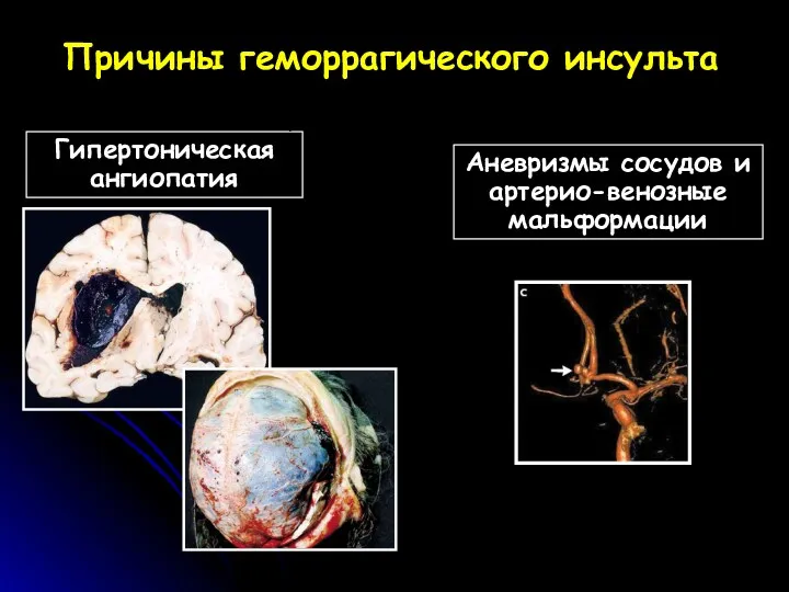 Гипертоническая ангиопатия Аневризмы сосудов и артерио-венозные мальформации Причины геморрагического инсульта