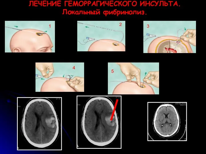 ЛЕЧЕНИЕ ГЕМОРРАГИЧЕСКОГО ИНСУЛЬТА. Локальный фибринолиз. 1 2 3 4 5