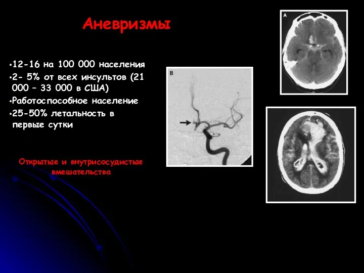 Аневризмы 12-16 на 100 000 населения 2- 5% от всех