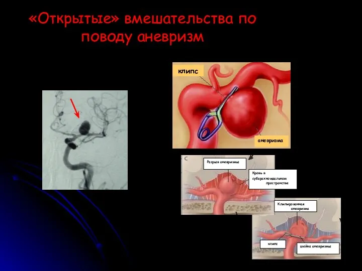 «Открытые» вмешательства по поводу аневризм клипс аневризма Разрыв аневризмы Кровь