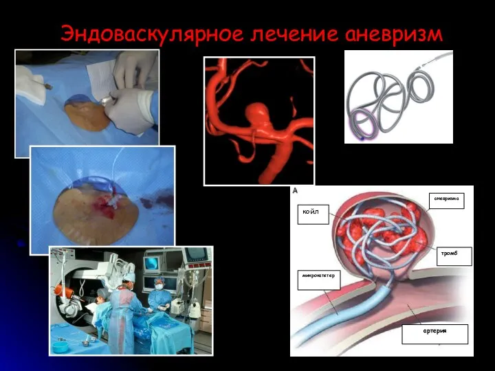 Эндоваскулярное лечение аневризм койл аневризма тромб артерия микрокатетер