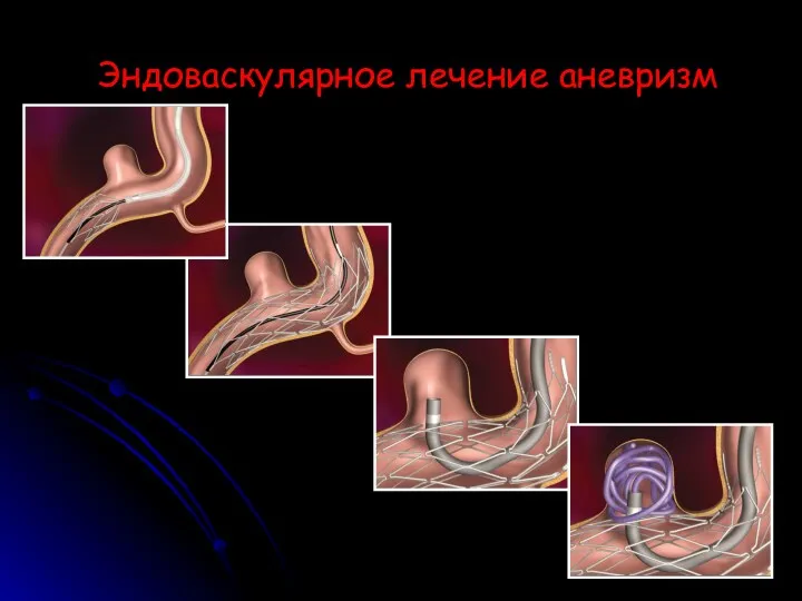 Эндоваскулярное лечение аневризм