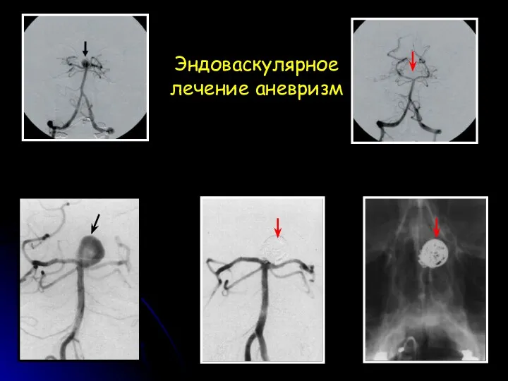 Эндоваскулярное лечение аневризм